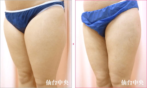 大腿臀部脂肪吸引 症例写真3