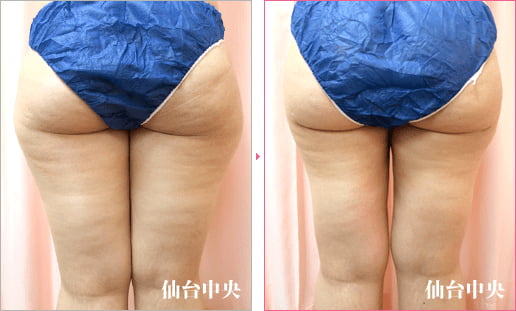 大腿臀部脂肪吸引 症例写真4